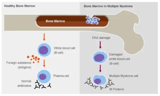 Multiple Myeloma